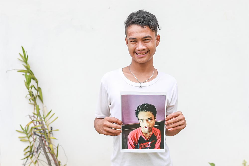 Angga smiling and holding a picture of himself before cleft surgery