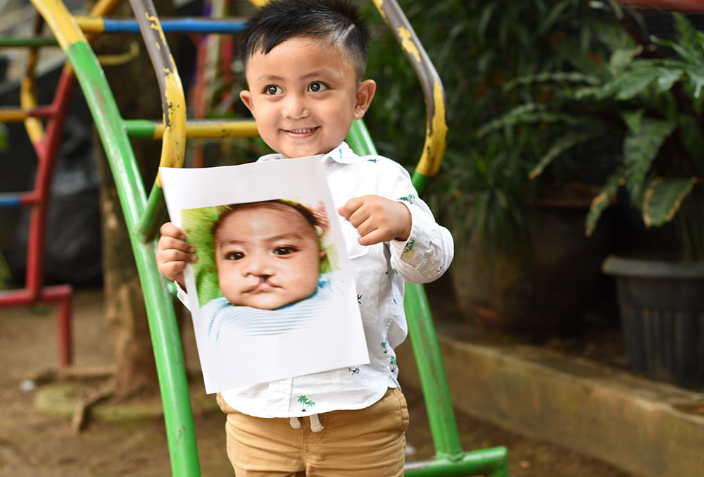 Biru smiling and holding a picture of himself before cleft surgery
