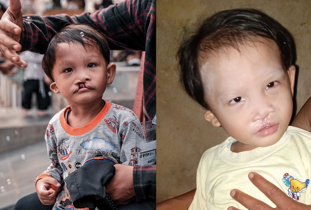 cleft-affected patient before and after cleft surgery