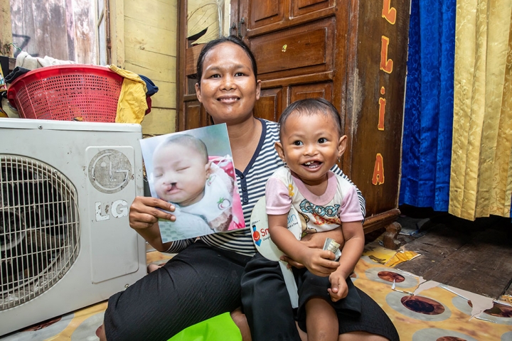 Karina tersenyum bersama ibunya Kisjayanti dan memegang foto dirinya sebelum operasi sumbing