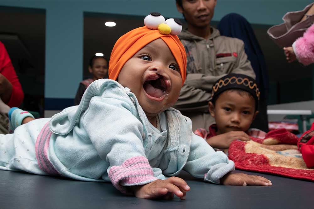 cleft-affected Smile Train patient