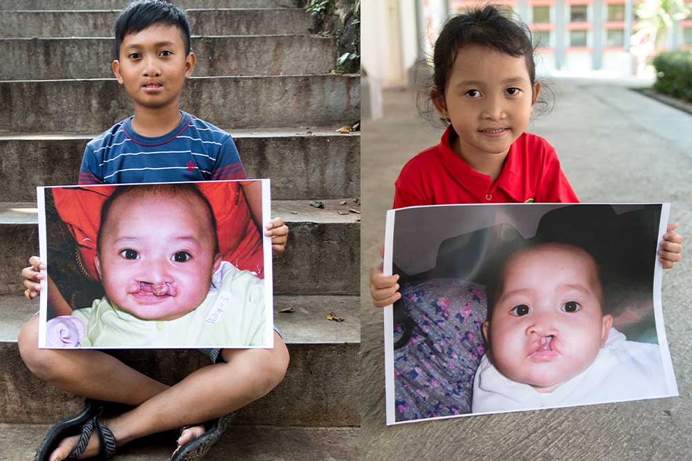 Nazwa and Wanqsa smiling and holding photos of themselves before cleft surgery