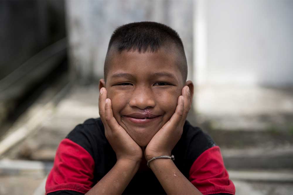 Aldan smiling and resting his hands on his cheeks after cleft surgery
