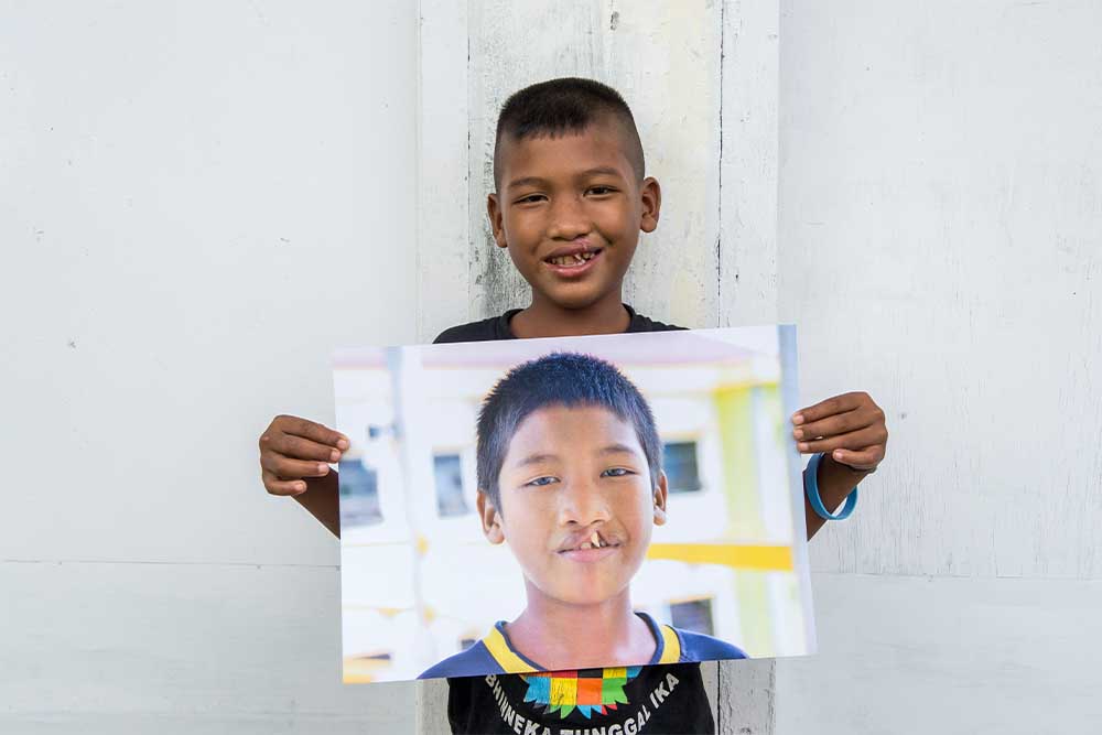 Aldan smiling and holding a picture of himself before cleft surgery