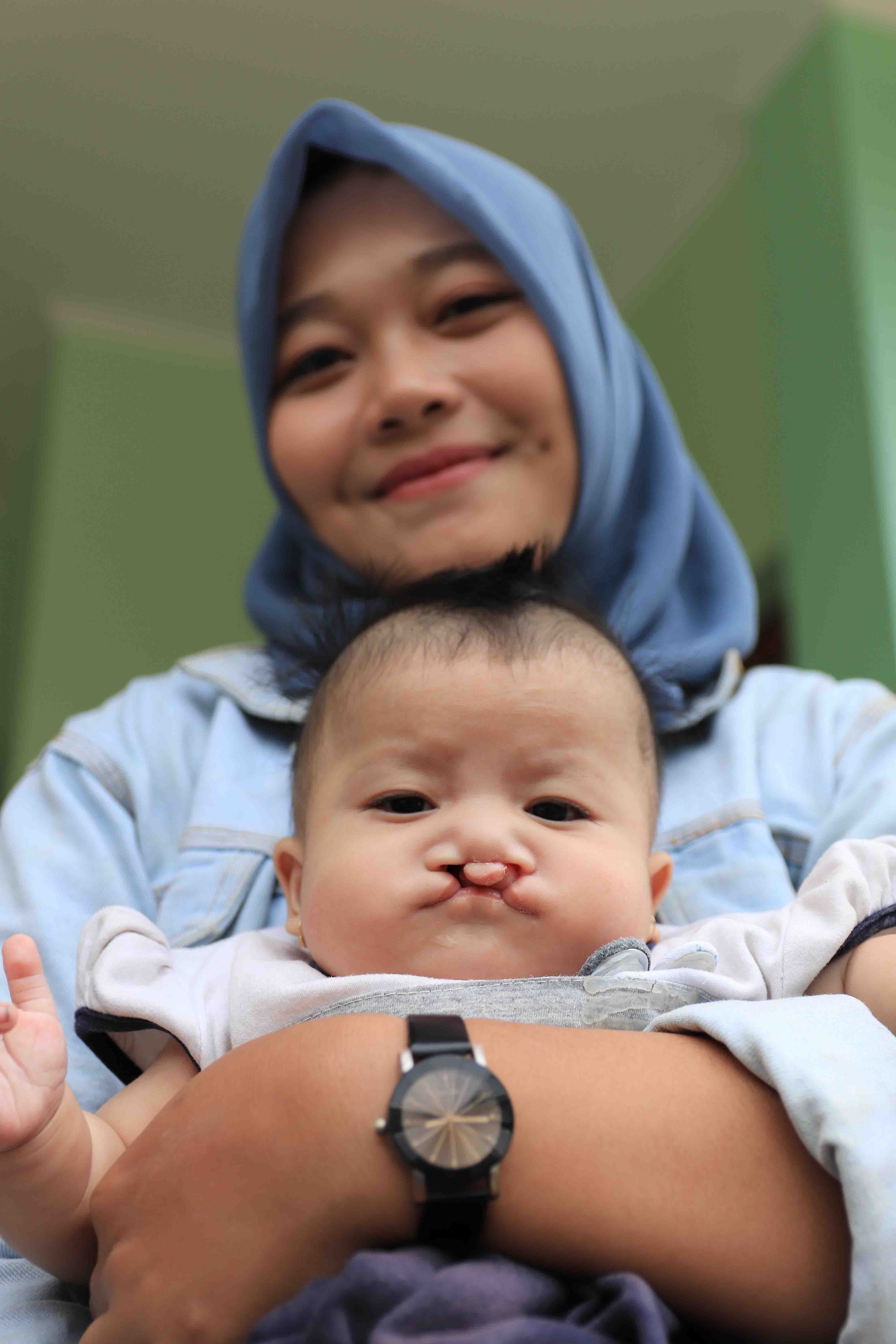 Cleft-affected child and their mother before cleft surgery