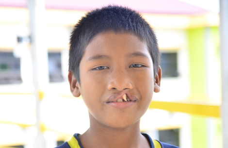 Cleft-affected boy before cleft surgery