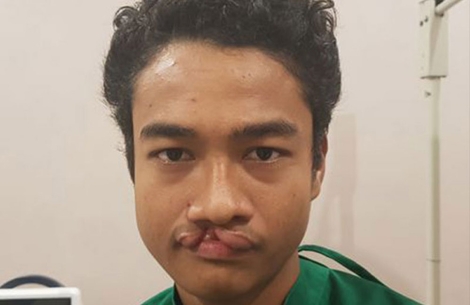 Angga before cleft surgery