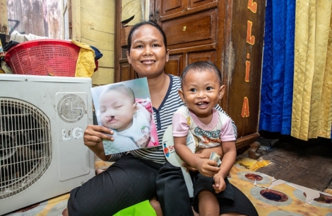 Karina tersenyum bersama ibunya Kisjayanti dan memegang foto dirinya sebelum operasi sumbing