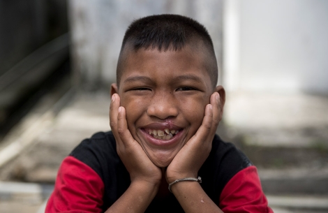 Pasien Smile Train tersenyum dengan tangan di wajahnya