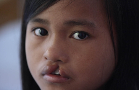 cleft-affected girl