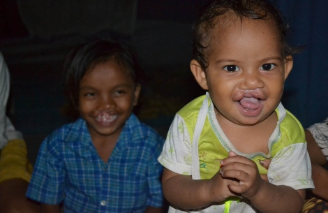 Two cleft-affected kids smiling