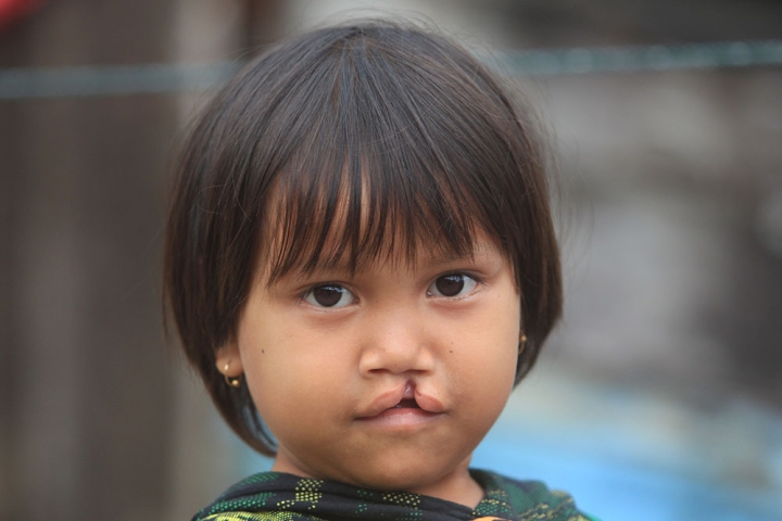 Cleft-affected girl before cleft surgery