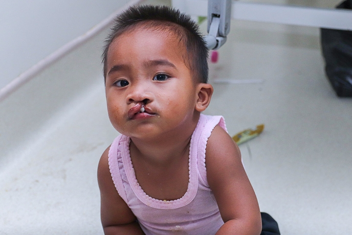 Cleft-affected baby before cleft surgery