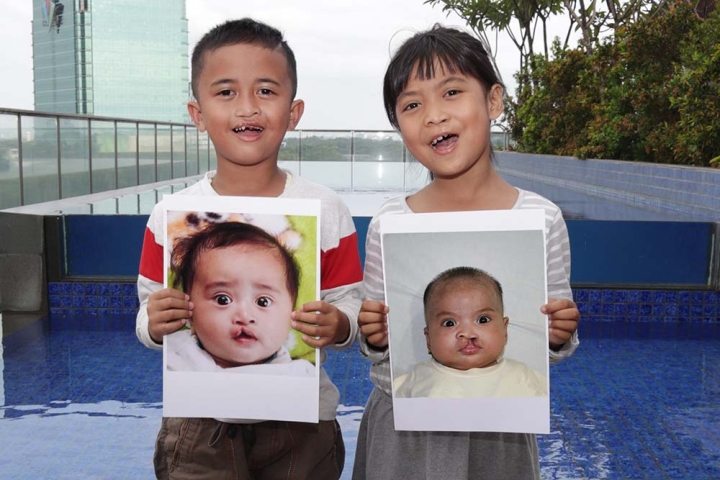 Two Smile Train patients smiling and holding photos of themselves before cleft surgery