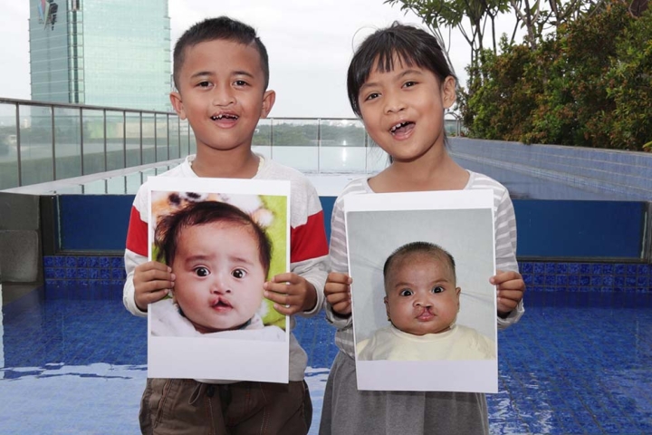 Dua pasien Smile Train tersenyum dan memegang foto diri mereka sebelum operasi sumbing