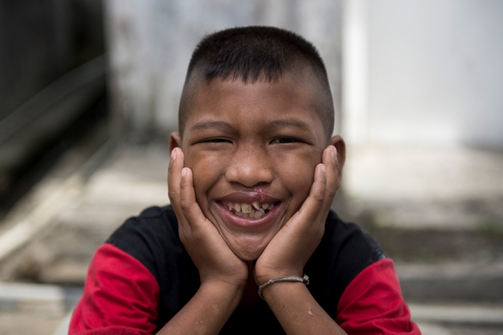 Pasien Smile Train tersenyum dengan tangan di wajahnya