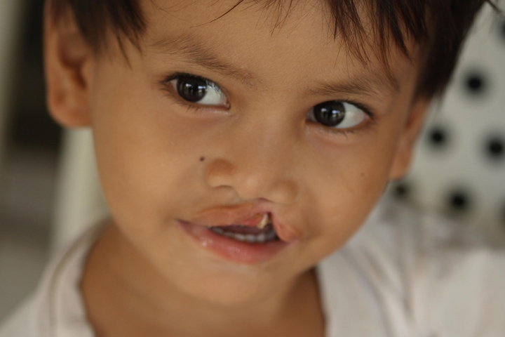 cleft-affected Smile Train patient before cleft surgery