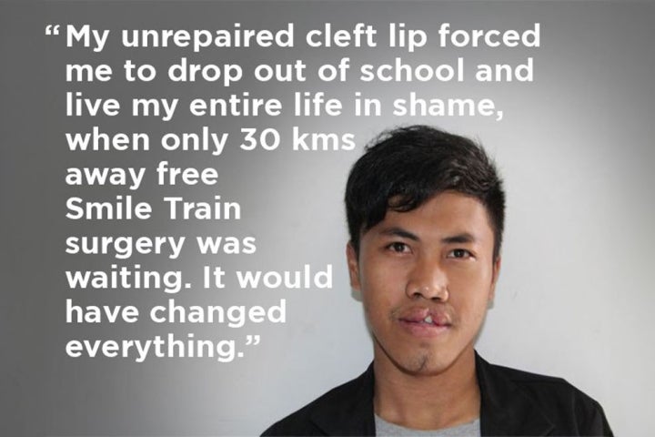 Sukma before cleft surgery - "My unrepaired cleft lip forced me to drop out of school and live my entire life in shame, when only 30 kms away free Smile Train surgery was waiting. It would have changed everything."