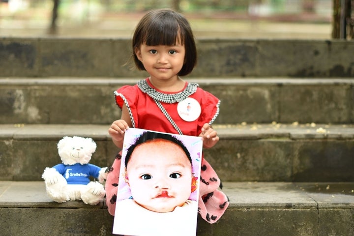 Khalisa tersenyum sambil memegang foto dirinya sebelum operasi sumbing di samping boneka beruang 