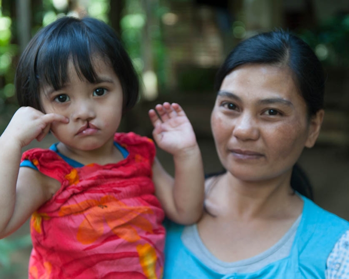 Cleft-affected girl with her mother