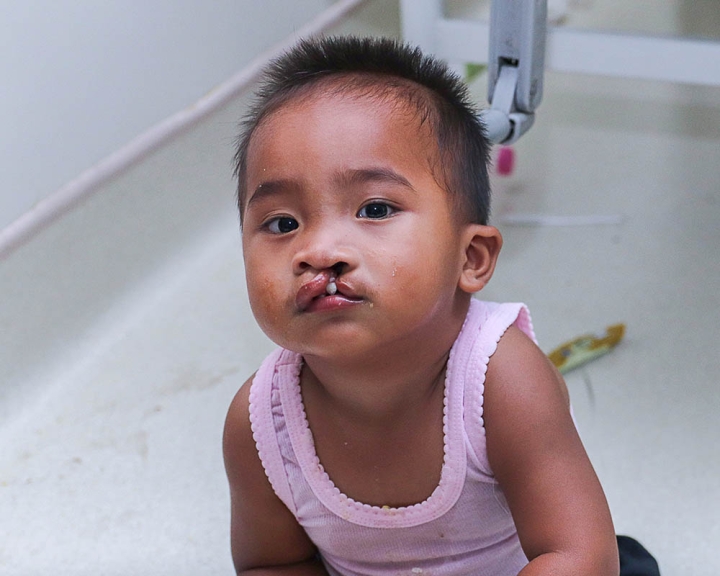 Cleft-affected baby before cleft surgery