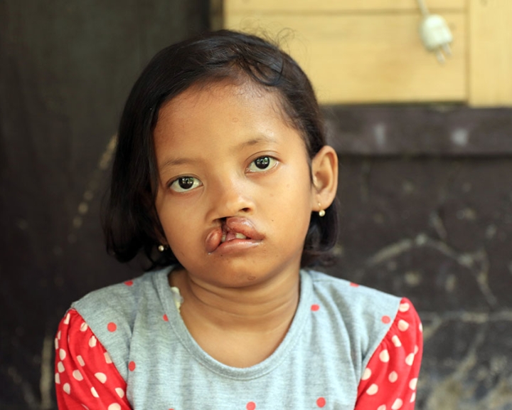 Ayu before cleft surgery
