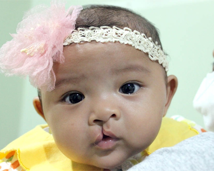 Cleft-affected baby before cleft surgery
