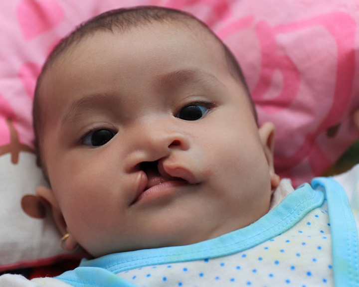 Cleft-affected baby before cleft surgery