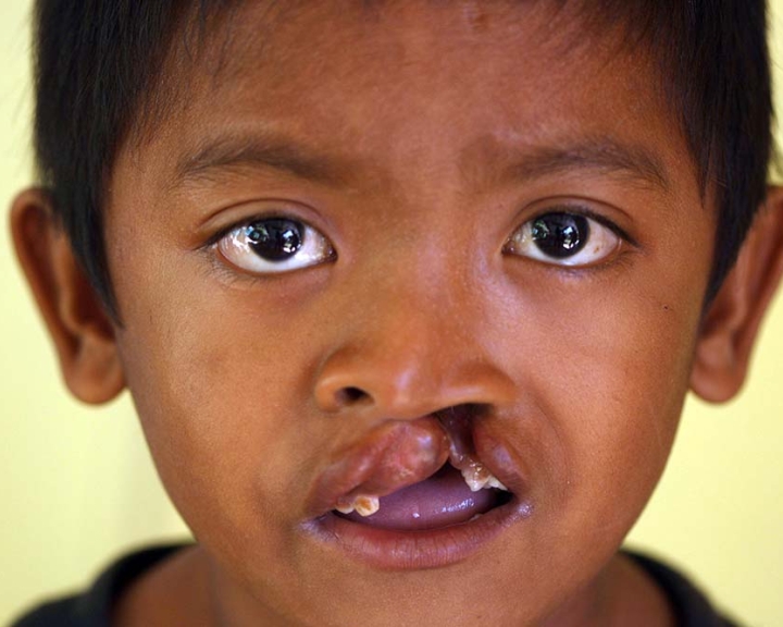 Boy with a cleft lip