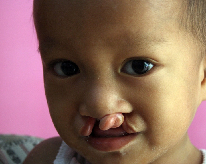 Baby with a bilateral cleft lip
