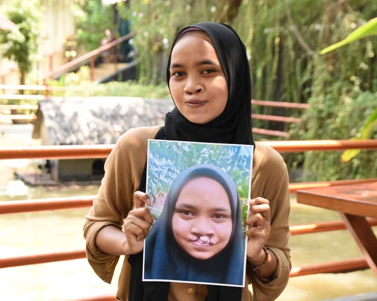 Cleft-affected woman smiling and holding a photo of herself before cleft surgery