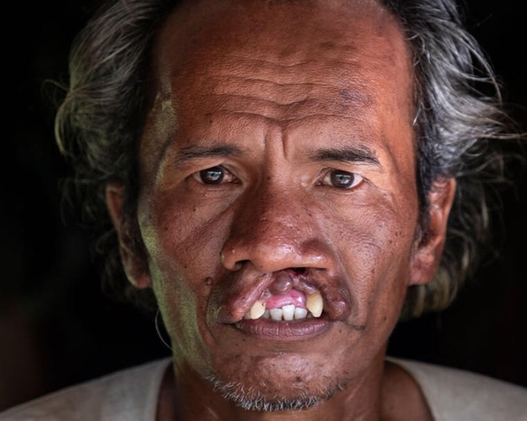 Alim sebelum operasi bibir sumbing