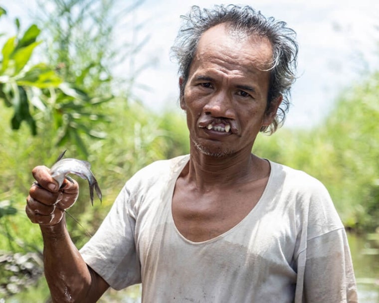 Alim memancing sebelum operasi bibir sumbing
