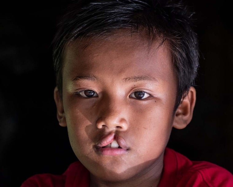 Rajib sebelum operasi bibir sumbing